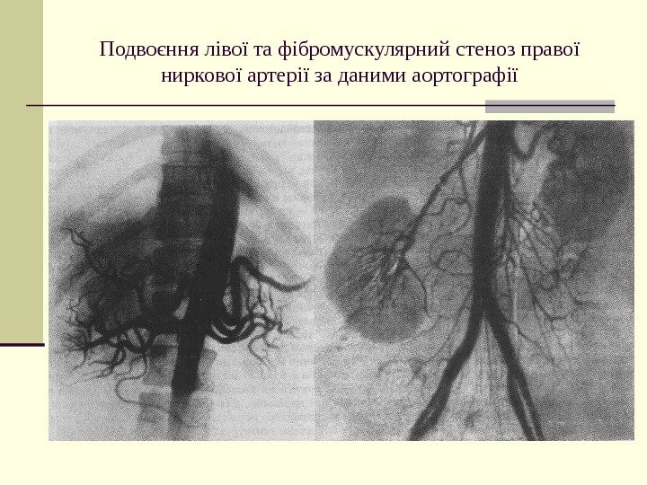   Подвоєння лівої та фібромускулярний стеноз правої ниркової артерії за даними аортографії 